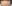額縮小術（生え際下げ・ヘアライン下降術） — 風が吹く日にも美容外科クリニック