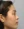 Thread embedding acupuncture lift (Korean-medicine 'maeseon' acupoint thread lift) — after · Roa Clinic