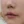 โบท็อกซ์ร่นร่องริมฝีปาก (Lip Flip ทำให้ร่องใต้จมูกดูสั้นลง) — หลังทำ (7วัน) · คลินิก Younme