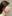 鼻尖形成術（自家軟骨移植） — ララ美容外科クリニック