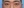 lower blepharoplasty (under-eye bag removal with fat repositioning) — before (7days) · Custom Plastic Surgery Clinic