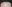 額縮小術（生え際下げ・ヘアライン下降術） — ザフィックス美容外科クリニック