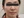 Chemical peel — before (7days) · Le Shine Clinic