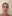 Under-eye (tear trough) fat grafting — Anersty Plastic Surgery Clinic