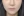 Paranasal (nasal base) augmentation with implant — after (30days) · Apgujeong Lee & Star Clinic