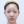 Eyelid filler (upper eyelid hollowing correction) — after · Galaxy Plastic Surgery Clinic