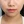 โบท็อกซ์ปีกจมูก — ก่อนทำ (14วัน) · คลินิก Only P