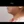 Platysma plication (corset platysmaplasty for double chin/jawline) — before (7days) · Olo Plastic Surgery Clinic