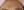 Botox for nasolabial folds — before (30days) · Ayun Clinic