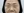 ฟิลเลอร์ใต้ตา (แก้ร่องใต้ตา / ขอบตาคล้ำ) — ก่อนทำ · ไอแบ็ค คลินิก
