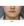 Volnewmer (โวลนิวเมอร์ ยกกระชับด้วย RF) — ก่อนทำ (30วัน) · คลินิกศัลยกรรมตกแต่งนาบี