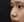 Protruding mouth correction (anterior segmental osteotomy / orthodontic setback) — before (30days) · ES Cheongdam Plastic Surgery Clinic