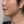 Density Lifting (RF skin tightening / lifting) — after · Ripain Clinic