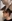 Double chin liposuction (submental liposuction) — Myong Plastic Surgery & Aesthetics