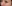 裏ハムラ法（経結膜的眼窩脂肪移動術） — ウリ美容外科クリニック