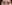 二重まぶた（自然癒着法） — プロミス美容外科クリニック