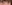 裏ハムラ法（経結膜的眼窩脂肪移動術） — ウリ美容外科クリニック