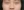 ตัดปีกจมูก (Alarplasty) — ก่อนทำ · คลินิกศัลยกรรม TJ (TJ Plastic Surgery)