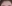 額リフト（前額リフト） — DM美容外科クリニック