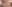 Lip filler (lip augmentation with HA) — Maison de M Clinic