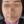 ฉีดไขมันตัวเองทั้งใบหน้า (ศัลยกรรมเติมไขมันใบหน้า) — หลังทำ (21วัน) · ซุนพลัสศัลยกรรมพลาสติก