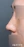 Nasal osteotomy (nasal bone narrowing) — after (7days) · Anersty Plastic Surgery Clinic