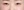 Insulated RF microneedle acne treatment (Agnes) — after (30days) · Remiel Plastic Surgery Clinic