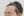 Forehead reduction (hairline lowering surgery) — before (12days) · Goyu Plastic Surgery Clinic