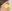 鼻尖形成術（自家軟骨移植） — ベリーグッド美容外科