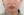 ตัดไขมันกระพุ้งแก้ม — ก่อนทำ (9วัน) · ไอรูมิ ศัลยกรรมพลาสติก