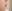 人中短縮（リップリフト） — プランナー美容外科クリニック