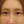 Full-face filler (full-face HA rejuvenation) — after · Project U Clinic
