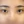 เปิดหางตา — หลังทำ (7วัน) · ไฮบอม ศัลยกรรมพลาสติก
