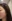 Rejuran Healer (salmon-DNA polynucleotide / PN skin booster) — Seoul Eye Plastic Surgery Clinic