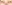 裏ハムラ法（経結膜的眼窩脂肪移動術） — ファクト美容外科クリニック