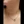 Neck wrinkle Botox (platysma band Botox / Nefertiti lift) — before (30days) · A-Top Plastic Surgery Clinic