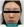 ฉีดไขมันตัวเองทั้งใบหน้า (ศัลยกรรมเติมไขมันใบหน้า) — หลังทำ (15วัน) · คลินิกเซรอน