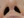 acne scar subcision / regenerative needling — before (50days) · Rodam Korean Medicine Clinic - Gangnam Branch