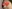 revision rhinoplasty — DM Plastic Surgery Clinic