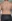 Abdominal fat-dissolving injection (injection lipolysis) — Beauty & Young Clinic
