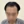 Scalp hair transplant — before (2days) · Okgeon Hairline Clinic