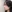 鼻尖形成術（自家軟骨移植） — OM美容外科クリニック