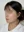 สลายไขมันใบหน้าด้วยเลเซอร์ (AccuSculpt) — หลังทำ (7วัน) · ยูไลน์คลินิก