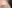 内視鏡下額（前額）リフト（エンドタイン固定） — ウリ美容外科クリニック
