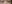 裏ハムラ法（経結膜的眼窩脂肪移動術） — プレジャー美容外科クリニック