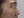 Nasal tip augmentation with implant — before (7days) · The Ollim Plastic Surgery Clinic