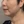 Density Lifting (RF skin tightening / lifting) — before · Ripain Clinic