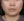 Radiesse (calcium hydroxylapatite filler / biostimulator) — before · Ripain Clinic