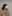 フェイスリフト（切開リフト） — DM美容外科クリニック