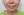 JUVGEN (autologous dermal regeneration / collagen-induction injection) — before (14days) · Saeroun Plastic Surgery